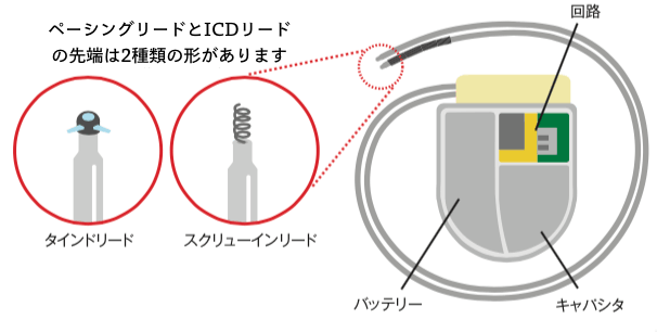 icd リード 構造