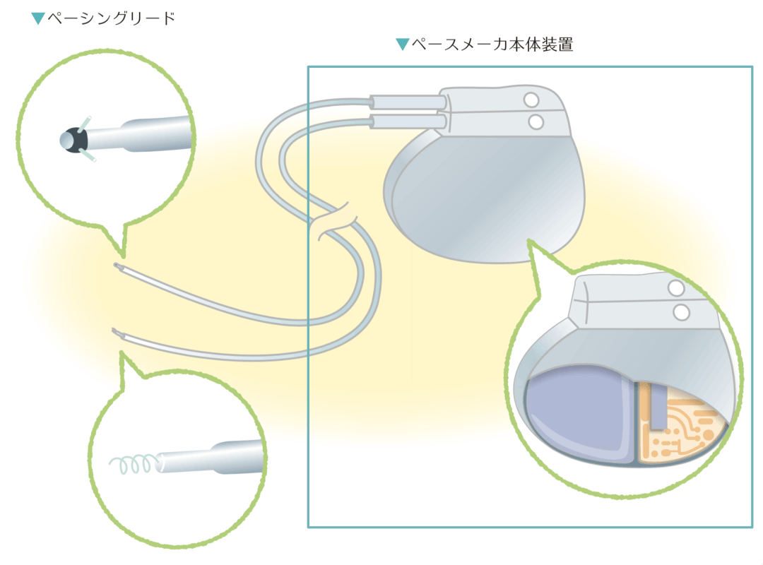 ペースメーカー セール リード と は