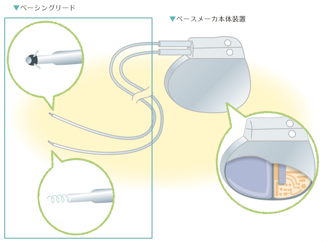 ペースメーカとペーシングシステムのはなし